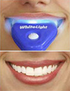 Купить Отбеливание зубов White Light